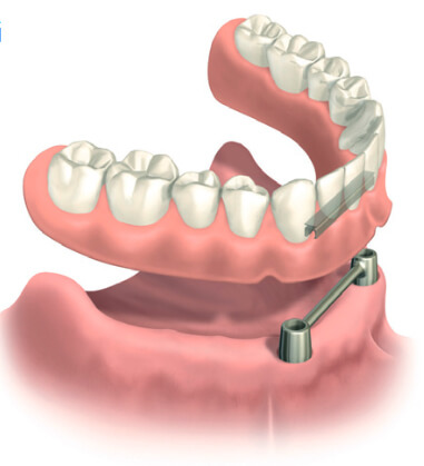 Implantaatprothese klikgebit